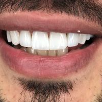 کامپوزیت دندان ارتودنسی ایمپلنت لمینت عصب کشی|خدمات آرایشگری و زیبایی|تهران, میدان ولیعصر|دیوار