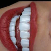مدل کامپوزیت ونیر به مدت یک هفته|خدمات آرایشگری و زیبایی|تهران, جنت‌آباد جنوبی|دیوار
