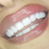 دندان مصنوعی لمینتی .اقساط|خدمات آرایشگری و زیبایی|تهران, نواب|دیوار