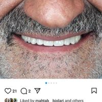 دست دندان مصنوعی طرح لمینیت|خدمات آرایشگری و زیبایی|تهران, تهرانپارس غربی|دیوار