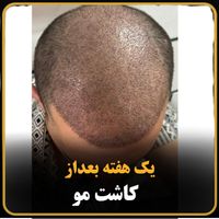 کاشت مو|خدمات آرایشگری و زیبایی|شیراز, فرهنگ شهر|دیوار