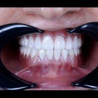 دست دندان مصنوعی طرح لمینیت|خدمات آرایشگری و زیبایی|تهران, تهرانپارس غربی|دیوار