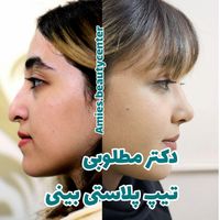 عمل جراحی زیبایی بینی تیپ پلاستی تخلیه غبغب بوکال|خدمات آرایشگری و زیبایی|تهران, شهرک غرب|دیوار