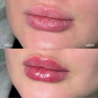 تزریق ژل و بوتاکس499|خدمات آرایشگری و زیبایی|تهران, عبدل‌آباد|دیوار