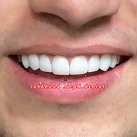 کامپوزیت دندان ،بریج دندان،بلیچینگ دندان|خدمات آرایشگری و زیبایی|اصفهان, شیخ صدوق|دیوار