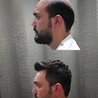 پروتزموترمیم مو پرپشتی مو در1جلسه|خدمات آرایشگری و زیبایی|اصفهان, نقش جهان|دیوار