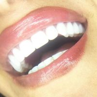 دندان مصنوعی لمینتی .اقساط|خدمات آرایشگری و زیبایی|تهران, نواب|دیوار