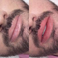 رفع تیرگی لب آقایان سیاهی لب|خدمات آرایشگری و زیبایی|تهران, دریاچه شهدای خلیج فارس|دیوار