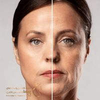 معجزه ای به نام اندولیفت|خدمات آرایشگری و زیبایی|تهران, گاندی|دیوار