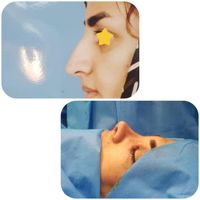 جراحی زیبایی بینی/رینوپلاستی|خدمات آرایشگری و زیبایی|تهران, آرژانتین|دیوار