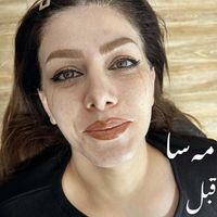 تزریق ژل لب روسی،بوتاکس،کانتورینگ عربی و روسی|خدمات آرایشگری و زیبایی|تهران, پاسداران|دیوار