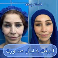 لیفت صورت باکشش عضله۲۴ملیون تاپایان امروز|خدمات آرایشگری و زیبایی|تهران, قیطریه|دیوار