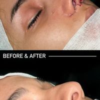 عمل جراحی بینی با دستگاه پیزو 22/لیفت صورت/پلک|خدمات آرایشگری و زیبایی|تهران, توانیر|دیوار