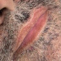 رفع تیرگی لب آقایان سیاهی لب|خدمات آرایشگری و زیبایی|تهران, دریاچه شهدای خلیج فارس|دیوار