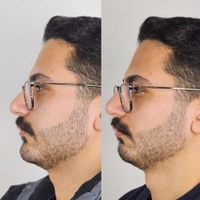 تزریق ژل  به صورت اقساطی بنا به شرایط خودتون|خدمات آرایشگری و زیبایی|تهران, یوسف‌آباد|دیوار