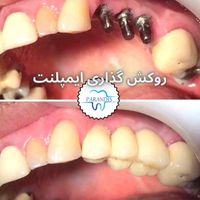 دندانپزشکی ایمپلنت پیوند جرمگیری بلیچینگ/اقساط|خدمات آرایشگری و زیبایی|تهران, پونک|دیوار