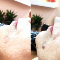 تزریق ژل و بوتاکس499|خدمات آرایشگری و زیبایی|تهران, عبدل‌آباد|دیوار