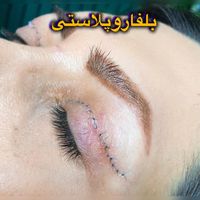 ساکشن غبغب بوکال فت بلفارو پیکرتراشی کاشت ابرو|خدمات آرایشگری و زیبایی|تهران, پونک|دیوار