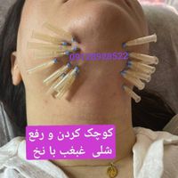 تزریق برای مدل مزو تراپی، مزو ژل، نخ|خدمات آرایشگری و زیبایی|تهران, مرزداران|دیوار