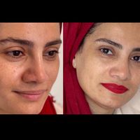 پاکسازی صورت/مزونیدلینگ/آر اف/پلاژن/کربوکسی تراپی|خدمات آرایشگری و زیبایی|تهران, هفت حوض|دیوار