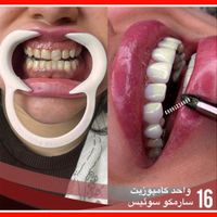 پالیش/ کشیدن دندان/لمینیت/ کامپوزیت در1جلسه/ روکش|خدمات آرایشگری و زیبایی|تهران, تهرانپارس غربی|دیوار