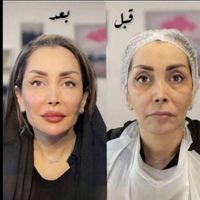 لحظه آخری جشنواره لیفت/جوانسازی با هایفو فقط ۸۹۰ت|خدمات آرایشگری و زیبایی|اصفهان, باغ دریاچه|دیوار