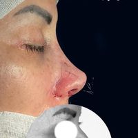 عمل جراحی بینی با دستگاه پیزو 22/لیفت صورت/پلک|خدمات آرایشگری و زیبایی|تهران, توانیر|دیوار