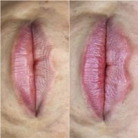 تزریق ژل  به صورت اقساطی بنا به شرایط خودتون|خدمات آرایشگری و زیبایی|تهران, یوسف‌آباد|دیوار
