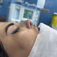 عمل بینی جراحی بینی|خدمات آرایشگری و زیبایی|تهران, شهرک غرب|دیوار
