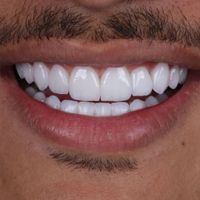 کامپوزیت دندان ارتودنسی ایمپلنت لمینت عصب کشی|خدمات آرایشگری و زیبایی|تهران, میدان ولیعصر|دیوار
