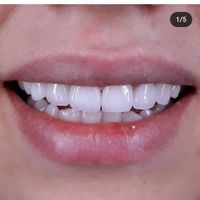 دست دندان مصنوعی طرح لمینیت|خدمات آرایشگری و زیبایی|تهران, تهرانپارس غربی|دیوار