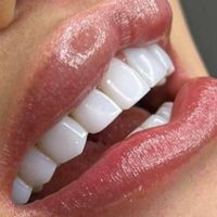 مدل کامپوزیت ونیر به مدت یک هفته|خدمات آرایشگری و زیبایی|تهران, جنت‌آباد جنوبی|دیوار
