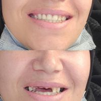 دندان مصنوعی پروتز دندانساز|خدمات آرایشگری و زیبایی|مشهد, پورسینا|دیوار