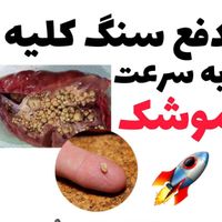 درمان کلیه سنگ ساز با ضمانت|خدمات آرایشگری و زیبایی|تهران, جمهوری|دیوار
