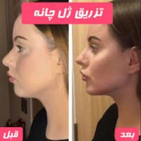 تزریق ژل چانه توسط پزشک|خدمات آرایشگری و زیبایی|تهران, صادقیه|دیوار