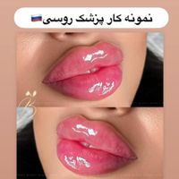 تزریق ژل ،بوتاکس ،لیفت با نخ وتزریق آنزیم|خدمات آرایشگری و زیبایی|تهران, صادقیه|دیوار