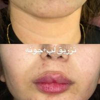 تزریق ژل و بوتاکس499|خدمات آرایشگری و زیبایی|تهران, عبدل‌آباد|دیوار