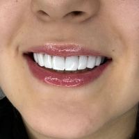 کامپوزیت دندان|خدمات آرایشگری و زیبایی|تهران, سلسبیل|دیوار