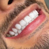 کامپوزیت دندان ارتودنسی ایمپلنت لمینت عصب کشی|خدمات آرایشگری و زیبایی|تهران, میدان ولیعصر|دیوار