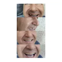 انجام کلیه خدمات دندان مصنوعی|خدمات آرایشگری و زیبایی|تربت‌حیدریه, |دیوار