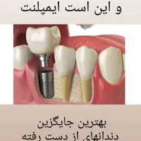 ایمپلنت لمینت کامپوزیت دندانپزشکی اقساطی