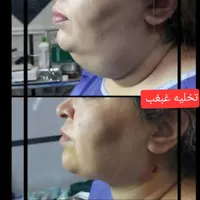 جشنواره تخلیه غبغب با تخفیف ویژه|خدمات آرایشگری و زیبایی|تهران, هاشمی|دیوار