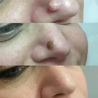برداشتن خال وزیگیل در یک جلسه|خدمات آرایشگری و زیبایی|تهران, مسعودیه|دیوار