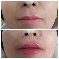جشنواره بوتاکس مصپورت ۴۵۰ت فیلر ۵۵۰ت|خدمات آرایشگری و زیبایی|اصفهان, رزمندگان|دیوار
