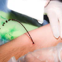 زالو،حجامت،فصد خون،مشاوره طب سنتی