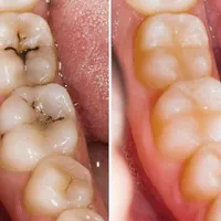 جرمگیری .سفید کردن دندان.روکش|خدمات آرایشگری و زیبایی|تهران, میرداماد|دیوار