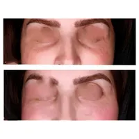 ژل زیرچشم شقیقه فیلر گودی چشم و شقیقه درمان گودی|خدمات آرایشگری و زیبایی|تهران, صادقیه|دیوار