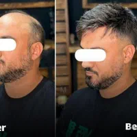 مرکز پروتز مو و کاشت مو