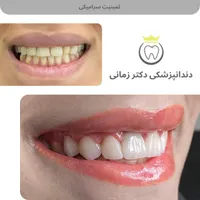 کامپوزیت و لمینت دیجیتال دندان با اقساط بلندمدت