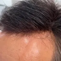 فروش اقساطی پروتز مو وارداتی درجه ۱|آرایشی، بهداشتی، درمانی|تهران, کوی فردوس|دیوار